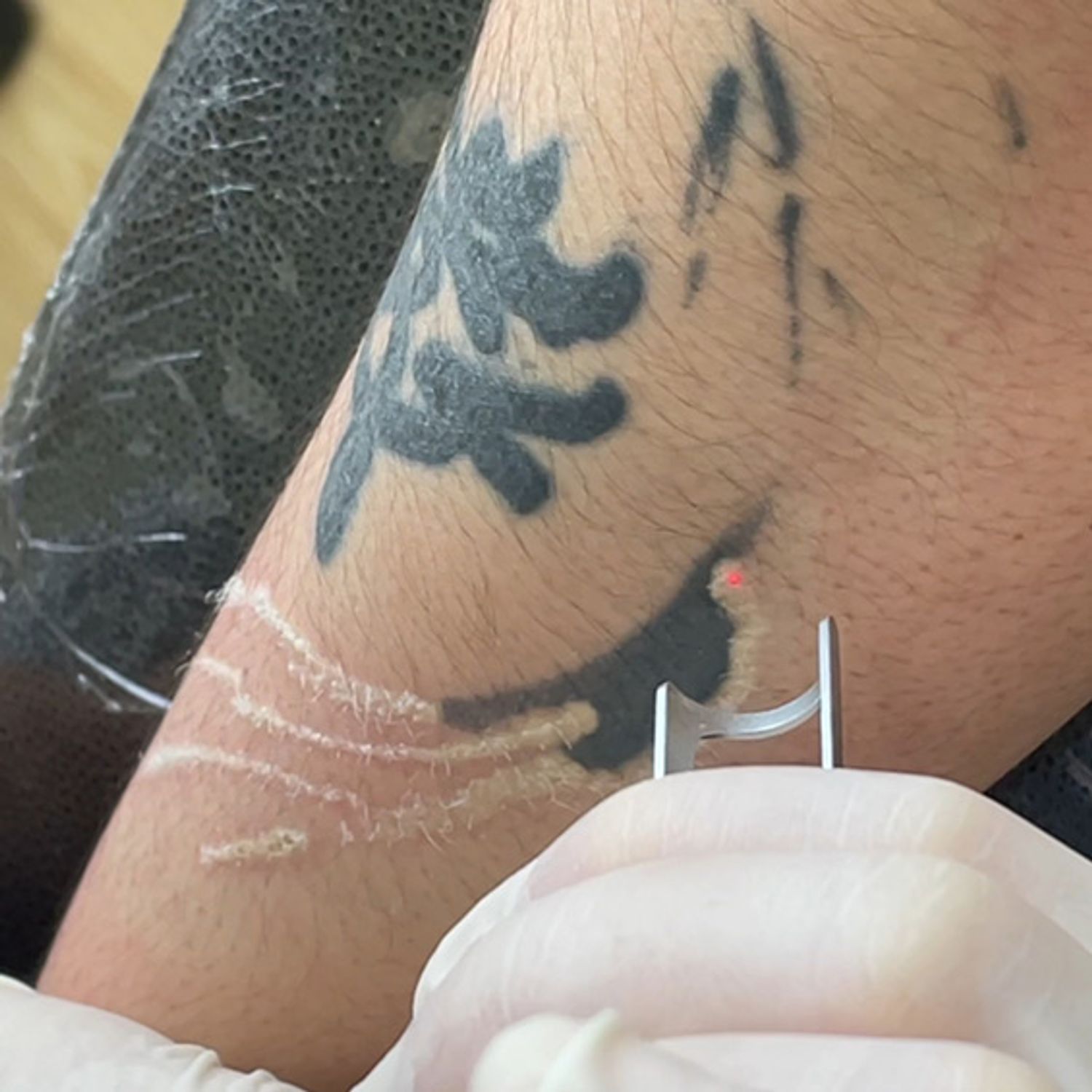 Close-up of a tattoo being removed using Jontelaser Q-Switch ND Yag Laser, highlighting precision treatment